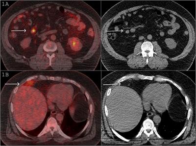 Case Report: All that glitters is not cancer; perihepatic hibernoma with fluctuating FDG uptake on PET/CT